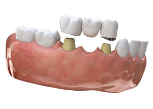 Fixed teeth set