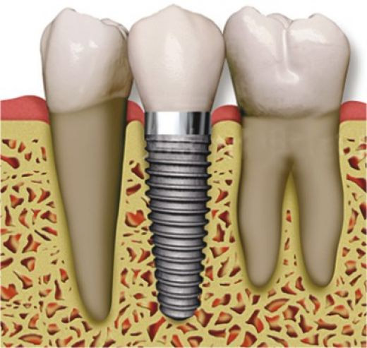 dental implant surgeon in bangalore