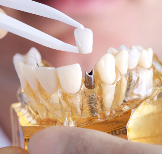 Immediate teeth fixing in Bangalore