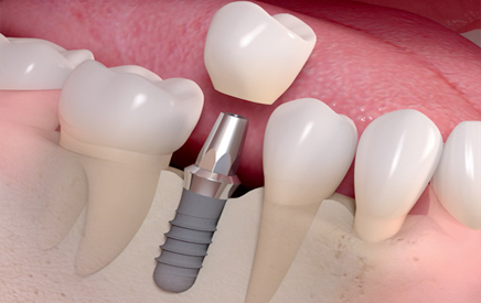 Dental implant