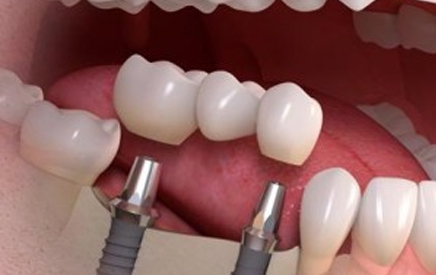 Multiple Teeth replacements
